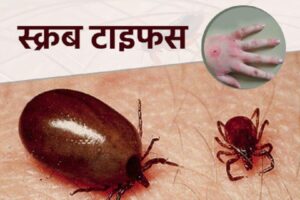 दार्चुलामा स्क्रबटाइफसका बिरामी बढ्दै दार्चुलामा स्क्रबटाइफसका बिरामी बढ्दै